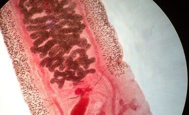 Anylostomosis in humans