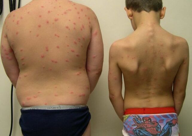 Skin rashes with worms