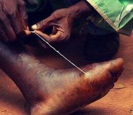 Parasite on a person's foot