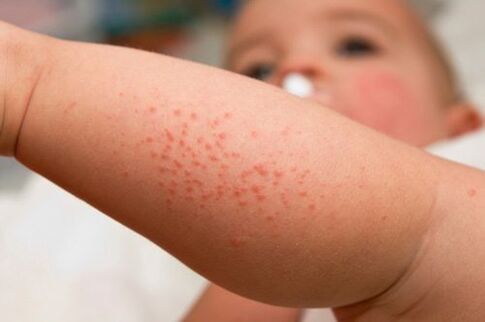 Allergy in a child as a symptom of the presence of worms.