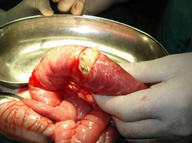 Ches parasites are dangerous to humans.